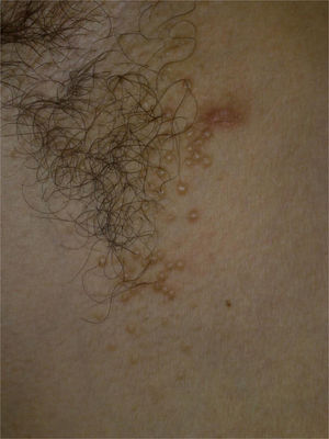 Axila direita apresentando pápulas cutâneas cor da pele, discretas e agrupadas, brilhantes, firmes, arredondadas, monomórficas e em cúpula, medindo de 1 a 3mm.