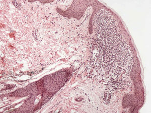 Infiltrado em uma papila dérmica aumentada, com crescimento descendente dos cones epidérmicos ao redor do infiltrado inflamatório dérmico no formato de “garra segurando uma bola” (Hematoxilina & eosina, 40×).