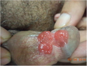 Crescimento bem definido, eritematoso, nodular, lobulado e séssil envolvendo a glande, o sulco coronal e o corpo do pênis.