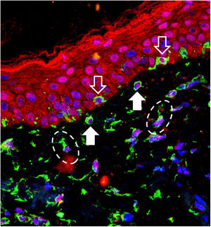 Imagem de sobreposição da imunofluorescência de tripla marcação na pele com melasma. Marcação em verde (vimentina), vermelho (Opsina‐3), azul (núcleos celulares). Seta com contorno branco: melanócitos na camada basal. Seta branca cheia: melanócitos em pêndulo. Elipses tracejadas: fibroblastos da derme superior.