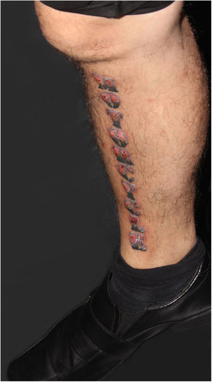 Aspecto clínico da tatuagem aproximadamente dois meses após o procedimento: infiltração e inflamação da área de pigmento vermelho.