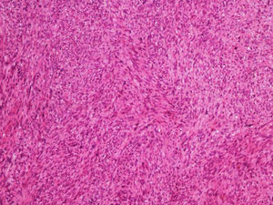 Leiomiossarcoma dérmico – médio aumento. O tumor é composto por fascículos entrelaçados de fibras de músculo liso (Hematoxilina & eosina, 100×).