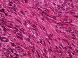 Leiomiossarcoma dérmico – grande aumento. As células são fusiformes, com núcleos alongados e extremidades rombas, nucléolo discreto e citoplasma eosinofílico fibrilar (Hematoxilina & eosina, 400×).