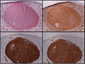Imuno‐histoquímica de leiomiossarcoma dérmico. (A), Imunomarcação para actina de músculo liso (40×); (B), imunomarcação para vimentina (40×); (C), imunomarcação para h‐caldesmon (40×); (D), Imunomarcação para HHF‐35 (40×).
