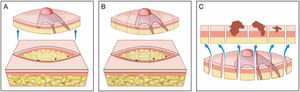 Cirurgia convencional. (A), Excisão elíptica com ampla margem cirúrgica ao redor do tumor. (B), Peça cirúrgica. As linhas pontilhadas indicam os cortes histológicos realizados verticalmente na peça, como se fosse um pão de forma (“bread‐loaf”). Esses cortes representam apenas cerca de 0,1% a 1% das margens cirúrgicas e podem deixar de detectar raízes do tumor durante o exame microscópico. Os três pontos correspondem a raízes do tumor que “ficaram” no paciente, mas não foram identificadas no exame microscópico porque não foram incluídas nos cortes histológicos examinados. (C), Correlação entre o material proveniente de exérese cirúrgica e a observação do tumor em corte longitudinal. As setas azuis indicam os cortes histológicos que são analisados na cirurgia convencional. Note a grande quantidade de margem não examinada (desenho inferior) no método convencional.