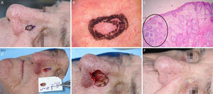 Carcinoma basocelular com grande extensão subclínica. (A), Margens cirúrgicas do primeiro estágio. (B), Marcação das margens do primeiro estágio com base na dermatoscopia, com telangiectasias finas e linhas brancas perpendiculares. Embora a figura mostre muitas telangiectasias ao redor da margem do primeiro estágio, essas telangiectasias foram interpretadas como sendo relacionadas ao fotodano, já que estavam amplamente distribuídas em área central da face. Após a avaliação de que as margens estavam livres, telangiectasias semelhantes ainda estavam presentes ao redor da ferida operatória. (C), Corte histológico da peça obtida na cirurgia micrográfica de Mohs demonstrando ninhos de células basaloides adjacentes ou aderidas à epiderme, alguns irregulares, compatíveis com carcinoma basocelular misto (Hematoxilina & eosina, 40×). Nos demais estágios, foi evidenciado predominantemente o componente superficial nas margens acometidas. (D), Mapa eletrônico do primeiro estágio. As linhas brancas indicam a presença de tumor residual. (E), Ferida operatória após seis estágios, com acometimento da parede nasal esquerda e região malar medial. (F), Pós‐operatório, dois meses. Região malar restaurada com fechamento primário e a parede nasal com enxerto de pele e cicatrização por segunda intenção.