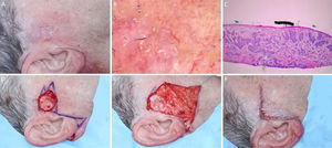 Carcinoma basocelular mal delimitado na região pré‐auricular direita. (A), Pré‐operatório. (B), Dermatoscopia demonstrou presença de telangiectasias arboriformes e áreas sem estrutura branco‐rosado brilhantes. (C), Corte debulking da peça obtida na cirurgia micrográfica de Mohs evidenciou ninhos irregulares de células basaloides compatíveis com carcinoma basocelular infiltrativo (Hematoxilina & eosina 25×). (D), Ferida operatória após dois estágios. Desenho do retalho de avanço. (E), Retalho descolado. Notar que a M‐plastia não foi realizada. (F), Pós‐operatório imediato.
