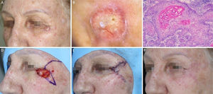 Carcinoma espinocelular em região periorbital esquerda. (A), Pré‐operatório. (B), Dermatoscopia: áreas amarelo‐esbranquiçado brilhantes e telangiectasias arboriformes. (C), Corte histológico da peça obtida na cirurgia micrográfica de Mohs demonstrou ceratinócitos atípicos com presença de pérolas córneas, compatíveis com carcinoma espinocelular bem diferenciado (Hematoxilina & eosina 100×). (D), Ferida cirúrgica e desenho do retalho de rotação. (E), Pós‐operatório imediato. (F), Pós‐operatório após seis semanas.