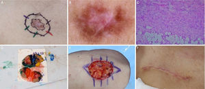 Dermatofibrosarcoma protuberans. (A), Dermatofibrossarcoma protuberans em região infraclavicular direita com margens do primeiro estágio demarcadas. (B), Dermatoscopia apresentando telangiectasias arboriformes finas e lineares, linhas brilhantes brancas, área amorfa rósea, envolta por rede pigmentar. (C), Corte histológico da peça obtida na cirurgia micrográfica de Mohs demonstrou proliferação fusocelular em derme e tecido celular subcutâneo, compatível com dermatofibrossarcoma protuberans (Hematoxilina & eosina 100×). Imuno‐histoquímica pré‐operatória foi positiva para CD34. (D), Tumor mapeado com diferentes cores. (E), Ferida cirúrgica e desenho do fechamento primário. (F), Pós‐operatório após um mês.