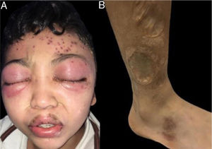 (A), Edema periorbital e eritema com erupções papulovesiculares frontais esquerdas com conteúdo hemorrágico. (B), Múltiplas cicatrizes atróficas e algumas anetodérmicas nos membros inferiores.