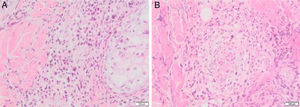 (A), Infiltrados linfoides perivasculares e perianexiais atípicos. (B), Angiocentricidade.