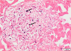 Hibridização in situ positiva para EBV (setas) (Hematoxilina & eosina, 100×).