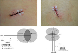 Marcação dos pontos da TBA com representação esquemática da metodologia proposta.