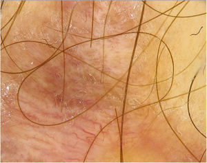Imagem dermatoscópica da primeira cicatriz. O padrão polimórfico com predomínio de vasos lineares irregulares era visível.