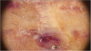 Imagem dermatoscópica da segunda cicatriz. O padrão vascular polimorfo consistia em vasos pontilhados e lineares juntamente com “área vermelho‐leitosa”.