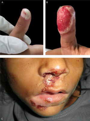 (A), Bolha na falange distal do polegar direito. (B), Ulceração contornada por retalho epidérmico na falange distal do polegar esquerdo. (C), Erosões com crostas e áreas hipocrômicas no nariz e lábios.