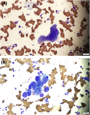 (A e B), Células escamosas multinucleadas com amoldamento nuclear e aparência de vidro fosco compatível com infecção viral por HSV (Giemsa, 400×).