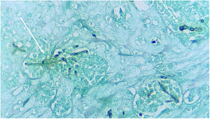 Exame histopatológico de cromoblastomicose. Seta tracejada: corpúsculos muriformes. Seta contínua: hifas demáceas (Grocott, 400×).