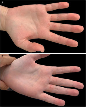 Apresentação clínica da disqueratose pagetoide nas mãos. (A), Pequenas pápulas eritematosas em face palmar de falanges proximais de 2°, 3° e 4° quirodáctilos à direita e (B), 3°, 4° e 5° quirodáctilos à esquerda.