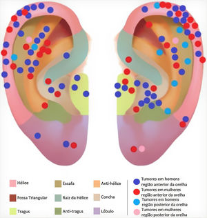 Localização dos tumores. *O conduto auditivo e o tumor nele localizado não estão representados na figura.
