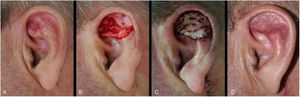 Enxerto de pele de espessura total para múltiplas subunidades auriculares. (A), Carcinoma basocelular mal delimitado. (B), Ferida operatória envolvendo escafa, anti‐hélice e fossa triangular com perda de cartilagem. (C), Pós‐operatório imediato. (D), Pós‐operatório tardio.