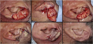 Retalho interpolado da região mastoide. (A), Ferida operatória envolvendo múltiplas subunidades, com perda significativa de cartilagem. (B), Retalho interpolado descolado. A incisão inferior foi realizada para retirada do enxerto de cartilagem da concha auricular (seta branca). (C), Enxerto de cartilagem (2,5×1 cm) suturado (seta branca). (D), Pós‐operatório imediato. Para a porção inferior da ferida foi realizado pequeno enxerto de pele. Uma pequena área na fossa escafoide foi deixada cicatrizar por segunda intenção. (E), Pós‐operatório imediato da segunda etapa da cirurgia (divisão do pedículo), realizada três semanas depois. (F), Pós‐operatório de um ano. A reposição de cartilagem foi fundamental para evitar contração da orelha.