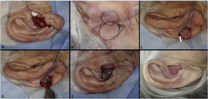 Retalho pull‐through. (A), Ferida operatória em concha auricular direita com perda de cartilagem. (B), Desenho do retalho. (C), Retalho descolado com pedículo em ilha. A seta branca indica o movimento do retalho. (D), Retalho atravessando a orelha após pequena incisão transfixante na concha. (E), Pós‐operatório imediato. (F), Pós‐operatório de um ano.