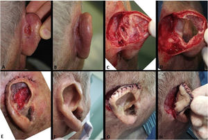 (A e B), CEC recidivado no sulco retroauricular. (C), Ferida operatória após o primeiro estágio da cirurgia de Mohs. A margem profunda estava totalmente comprometida, mesmo no local onde havia sido removida a cartilagem. (D), Defeito cirúrgico final envolvendo região retroauricular (sulco retroauricular) e espessura total do pavilhão (quase a totalidade da anti‐hélice e fossa triangular). Foi possível preservar a hélice. (E), Pós‐operatório imediato. O pavilhão foi fixado na região retroauricular/mastoide. A área do defeito de espessura total cicatrizou por segunda intenção. (F), Pós‐operatório. (G e H), Após meses, em um segundo momento, houve descolamento do pavilhão da região retroauricular e realização de enxerto de pele total (retirado da região supraclavicular) na face posterior do pavilhão. A área retroauricular foi deixada cicatrizar por segunda intenção.