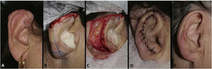 Retalho de avanço da hélice. (A), Carcinoma basocelular mal delimitado na hélice direita. (B), Ferida operatória de espessura total com perda do contorno da hélice. (C), Retalho descolado. (D), Pós‐operatório imediato. (E), Pós‐operatório tardio.