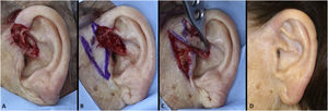 Retalho de transposição pré‐auricular para raiz da hélice. (A). Ferida operatória envolvendo raiz da hélice com perda de cartilagem. (B), Desenho do retalho. (C), Movimento do retalho. (D), Pós‐operatório de dois meses.