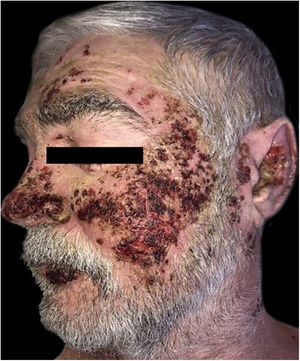Pênfigo vulgar e comportamento obsessivo‐compulsivo. Múltiplas lesões recobertas por crostas hematomelicéricas na face.