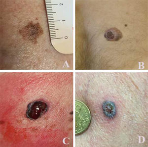 Exemplos de lesões e qualidade de imagem adquiridas com celular e encaminhadas para galliera.telederm.it. (A), Homem de 83 anos de idade, região dorsal: melanoma T1a; (B), homem de 36 anos de idade, região dorsal: melanoma T2b; (C), mulher de 68 anos de idade, flanco esquerdo: melanoma T3b; (D), homem de 72 anos de idade, braço esquerdo: carcinoma basocelular pigmentado.