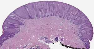 No pequeno aumento, há lesão muito bem demarcada, com acantose proeminente e hiperplasia psoriasiforme. Ceratinócitos claros e pálidos estão caracteristicamente presentes nesta lesão (Hematoxilina & eosina, 2×).
