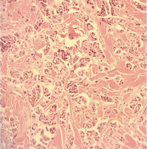 Células neoplásicas de tamanho médio organizadas em ninhos (Hematoxilina & eosina, 400×).