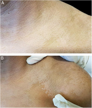Manobra propedêutica semiológica de Zirelí em lesão de pitiríase versicolor no ombro esquerdo: (A) em repouso; (B) após o estiramento (sinal de Zirelí), provocando o destacamento de escamas furfuráceas e tornando as lesões evidentes.