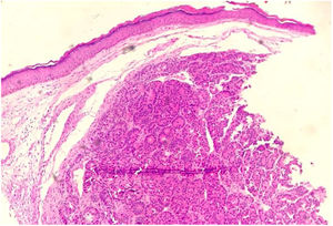 Derme infiltrada por células neoplásicas dispostas em padrão organoide (Hematoxilina & eosina, 4×).