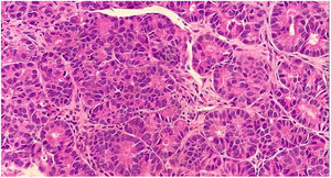 Células com núcleos arredondados, hipercromáticos, citoplasma eosinofílico, dispostas em padrão organoide (Hematoxilina & eosina, 40×).