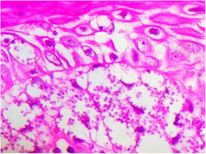 Macrófagos vacuolados com abundantes formas amastigotas (Hematoxilina & eosina, 400×).