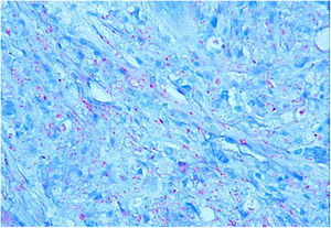 Microscopia óptica. (A), Pequeno aumento com presença de zona Grenz; infiltrado linfo‐histiocitário distribuído ao longo de toda a derme, entremeando fibras de colágeno (Hematoxilina & eosina, 40×). (B), Histiócitos de citoplasma claro vacuolizados, junto de infiltrado linfocitário (Hematoxilina & eosina, 200×). (C), Detalhe da zona Grenz; múltiplos histiócitos, alguns fusiformes, dispostos em padrão estoriforme (multidirecionados; Hematoxilina & eosina, 100×). (C).