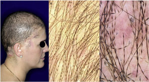Mulher de 34 anos de idade. (A) Aspecto clínico. (B) Tricoscopia (aspecto macroscópico). (C) Tricoscopia (aumento 70×).