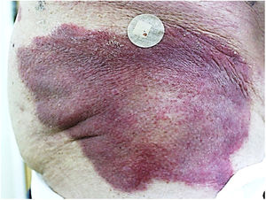 Placa eritematosa, infiltrada, bem delimitada, com borda levemente descamativa em lateral direita do quadril.