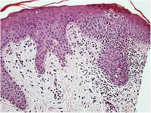 Histopatologia: epiderme com acantose e espongiose que compromete principalmente o acrossiríngeo, derme com leve infiltrado inflamatório perivascular superficial (Hematoxilina & eosina, 200×).