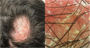 Placa de alopecia eritemato‐descamativa na região do vértice craniano de aproximadamente 5cm no maior diâmetro. Dermatoscopia demonstrou eritema e descamação folicular e interfolicular, sugerindo padrão de eczema.