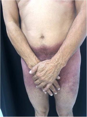 SDRIFE: máculas eritemato‐purpúricas acometendo região suprapúbica, lateral das coxas e região inguinocrural.