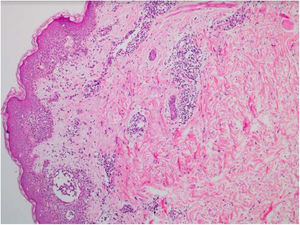 SDRIFE: Histopatologia evidenciando infiltrado linfo‐histiocitário perivascular na derme superficial e média (Hematoxilina & eosina, 100×).