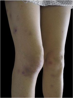 Nódulos eritematosos subcutâneos nas coxas e pernas.