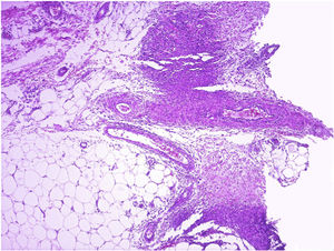 Infiltrado inflamatório neutrofílico na hipoderme e paredes vasculares, (Hematoxilina & eosina, 40×).
