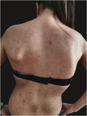 Sinais clínicos de neurofibromatose tipo 1 e dermatite atópica. Lesões eczematosas, com eritema, secreção e formação de crostas, várias manchas cafe‐au‐lait, sardas, neurofibromas cutâneos.