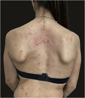 Remissão da dermatite atópica após quatro semanas de tratamento com dupilumabe. Lesões eczematosas residuais, como vistas no pescoço, determinaram um escore EASI de 4.