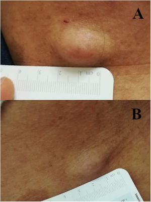 (A), Neurofibroma cutâneo antes de iniciar o tratamento com dupilumabe. (B), A mesma lesão mostra redução evidente do edema e da consistência após quatro semanas de terapia.